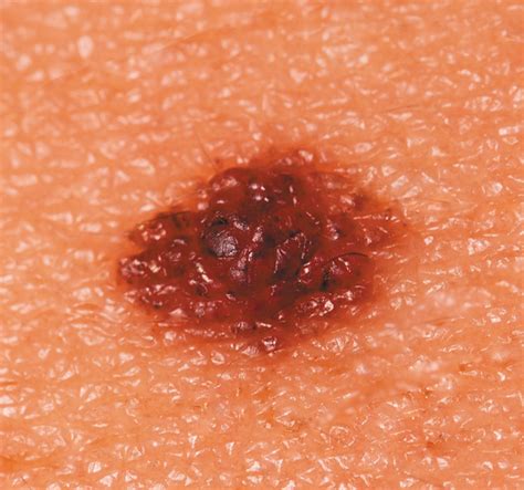 Age Spots—or Signs Of Skin Cancer University Health News