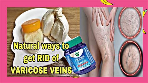 Natural Home Remedy For Varicose Veinsvaricose Veins Treatment At Homekapitbahaytv Youtube