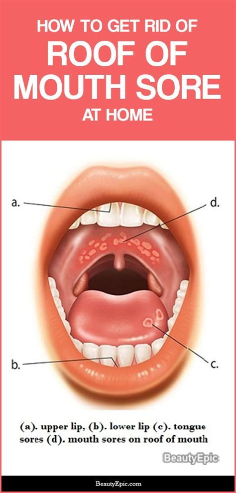 Simple Ways To Get Rid Of Roof Of Mouth Sore At Home Roof Of Mouth