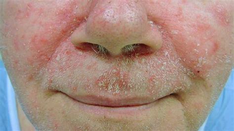 Red Flaky Nose It May Be Seborrheic Dermatitis