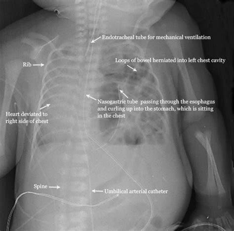 About Congential Diaphragmatic Hernia Cdh