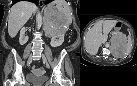 Steroid Profiling In The Diagnosis Of Malignant Adrenal Masses Cases