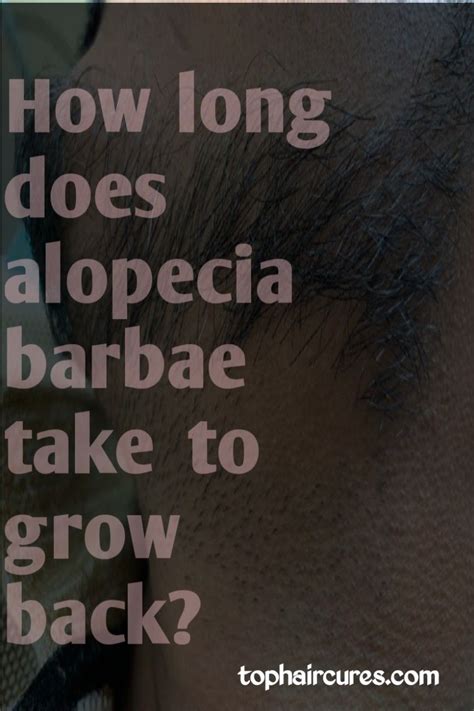 Alopecia Barbae Treatments In 2021 Alopecia Barbae Alopecia Hair