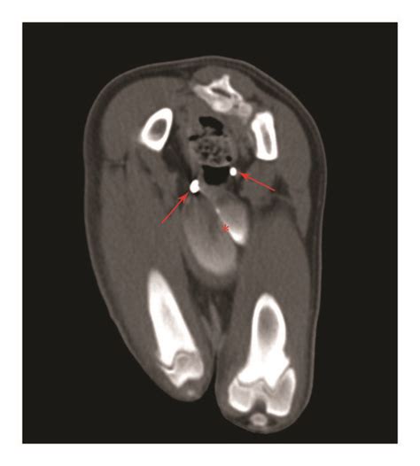 Transverse Ct Image At The Level Of The Ischium With Nonionic