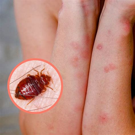 Tips To Prevent Bed Bug Bite Marks From Leaving Scars Bed Bug Sos