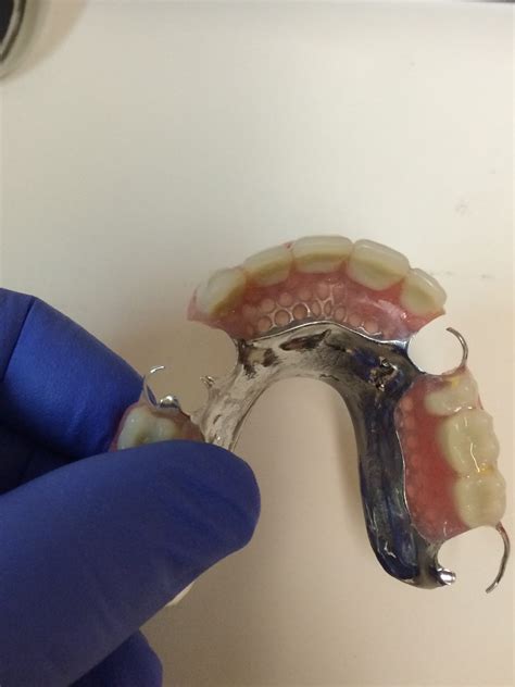 Partial Denture Upper Dunnville Denture Clinic
