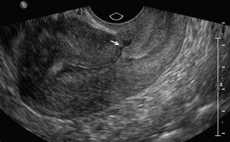 Cesarean Scar Defects An Underrecognized Cause Of Abnormal Uterine