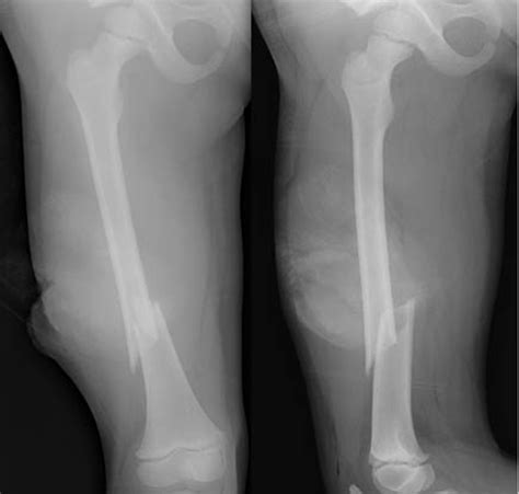 X Ray Showing Right Femur Fracture Download Scientific Diagram