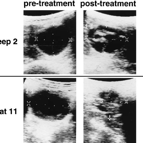 Ultrasound Changes In Hydatid Cysts In Liver Tissue Before And After 4