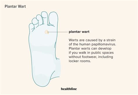 Plantar Wart What Is It Symptoms Treatment And More