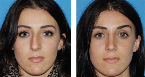 In some cases, surgery to reshape the nose (rhinoplasty) is performed at the same time as septoplasty. Deviated Septum: Causes, Symptoms, Diagnosis, Treatment ...