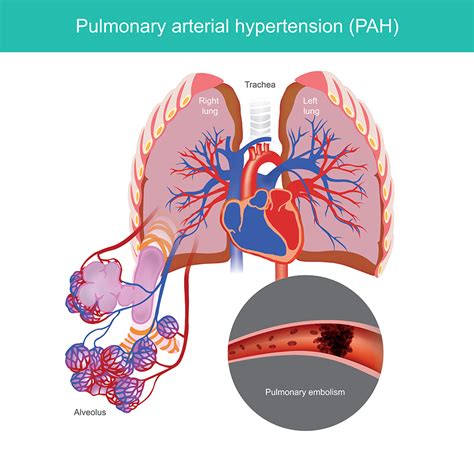 Know Pulmonary Artery Hypertension Symptoms And Treatment Dr Raghu