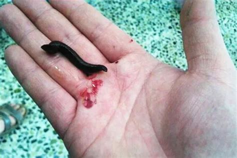 Doctors Find Leech Growing Inside Boy After He Complained Of A Sore