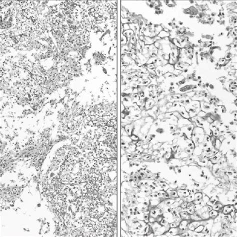 Histopathologic Appearance The Cells Had Pale Clear Cytoplasm With A