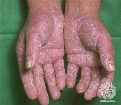 Hand Dermatitis Dorothee Padraig South West Skin Health Care
