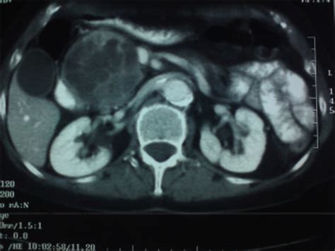 Abdominal Computed Tomography Scan Showing A 9cm Large Head Of Pancreas