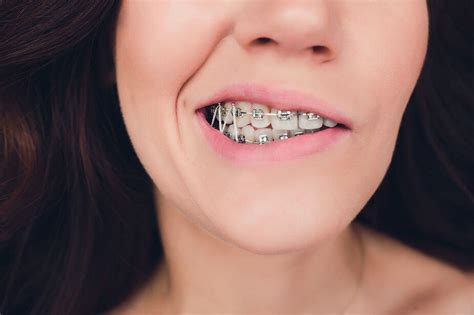 Answers To Common Questions About Orthodontics Part 2 All About The Rubber Bands
