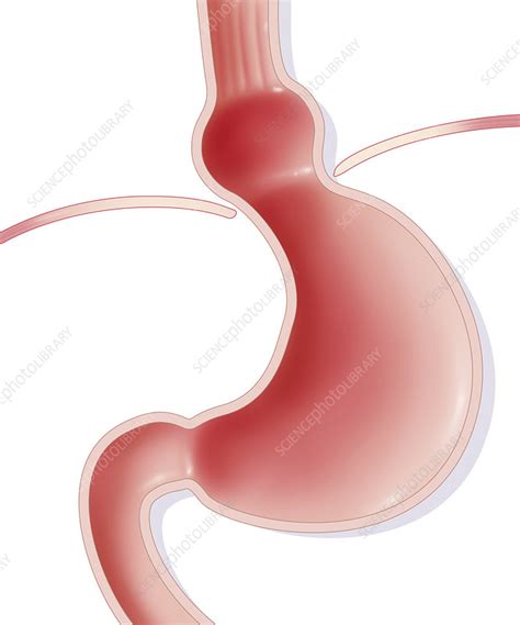 Hiatal Hernia Drawing Stock Image C0171902 Science Photo Library