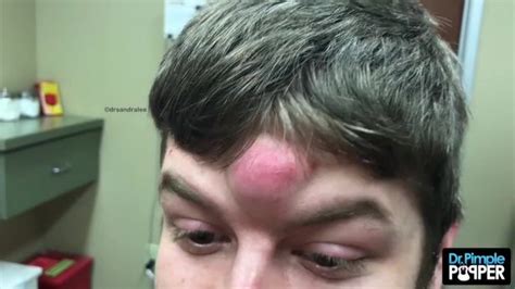 Dr Pimple Popper Removes Huge Unicorn Cyst From Mans Forehead In