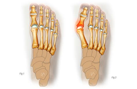 Hallux Valgus Symptoms Treatment And Surgery Orthopedic Surgical