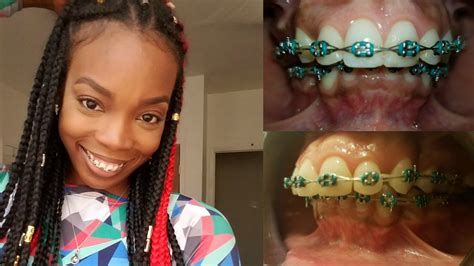 Adult Braces Update How I Clean Them Gaps And A New Overbite