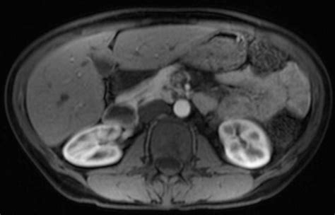 Pancreatic Divisum Body Mr Case Studies Ctisus Ct Scanning