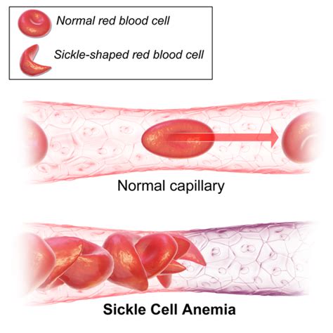 Sickle Cell Disease Or Anemia And Crispr Cas9 Genome Editing Owlcation