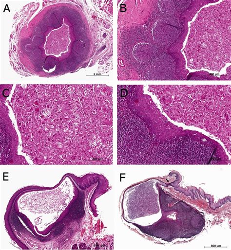Classical Histopathological Features Of The Oral Lymphoepithelial