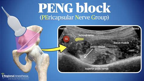 PENG Block Pericapsular Nerve Group Block YouTube
