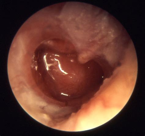 Chronic Otitis Media Causes Complications Management Teachmesurgery