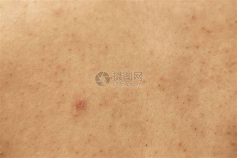 女人的问题皮肤痤疮疤痕油皮肤和毛孔黑斑和脸上高清图片下载 正版图片504135980 摄图网