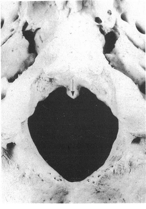 Figure 1 From A Tubercle At The Anterior Margin Of The Foramen Magnum