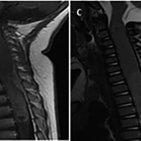 Preoperative Mri Cervical Spine With And Without Gadolinium A T1