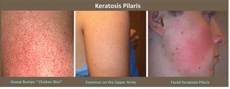 Keratosis Pilaris Treatment Plano Tx Chicken Skin Treatment Frisco Tx