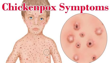 Chickenpox Symptoms Common Sign And Symptoms Of Chickenpox Youtube