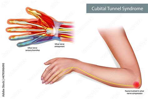 Fototapeta Medical Illustration To Explain Cubital Tunnel Syndrome