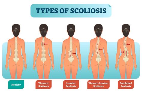 Scoliosis Treatment In Kl Chiropractic And Physiotherapy Spinefit
