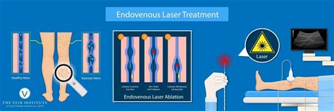 3 Benefits Of Endovenous Ablation Laser Treatment The Vein Institute