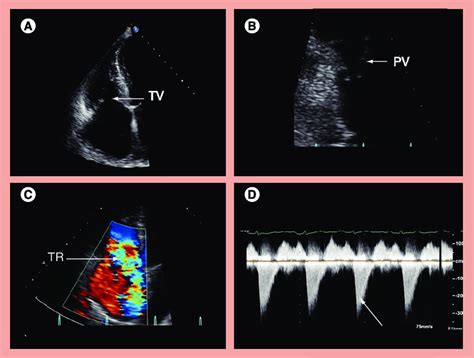 2d Echocardiogram In Carcinoid Heart Disease A Thickened Retracted
