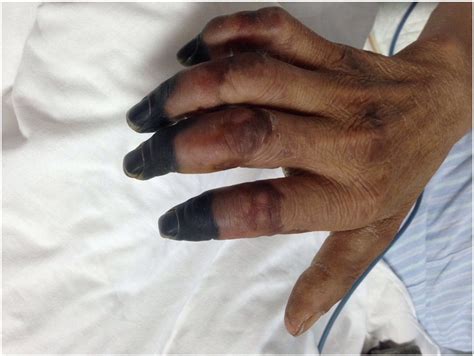 Cutaneous Gangrene Of The Arms And Legs After Cardiopulmonary