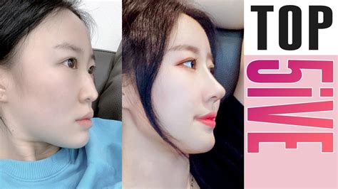 Sub Top 5 Dramatic Korean Plastic Surgery Before And After Change