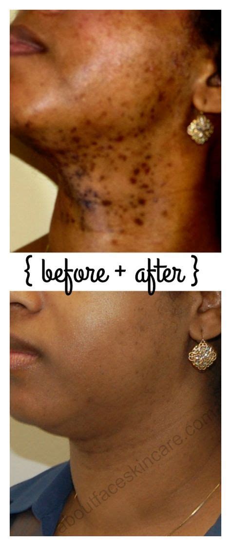 Laser Hair Removal Before And After Chin Is Great Newsletter Photography