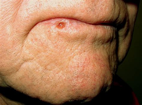 Squamous Cell Carcinoma Skin Cancer Institute