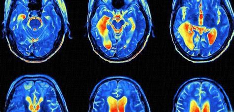 Lsds Impact On The Brain Revealed In Groundbreaking Images Medicine