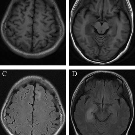 Brain Magnetic Resonance Imaging Findings Of A Young Female Patient Download Scientific Diagram