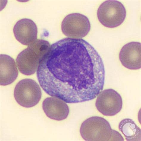 Myelocyte And Metamyelocyte