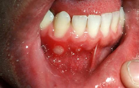 Aphthous Stomatitis Treatment