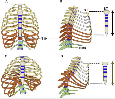 Anatomy Of Ribs And Sternum Costochondritis Causes Symptoms
