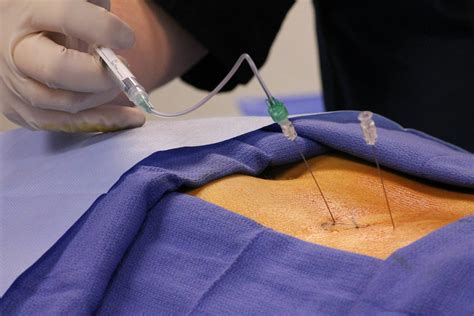 Efficacy Of Epidural Steroid Injections For Treating Lower Back Pain