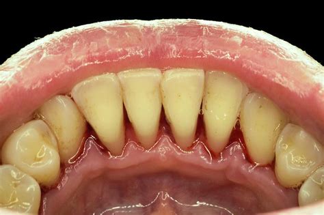 Teeth After Ultrasonic Cleaning Photograph By Dr Armen Taranyan